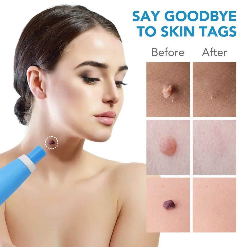 PAINLESS AUTO SKIN TAG  REMOVER KIT™